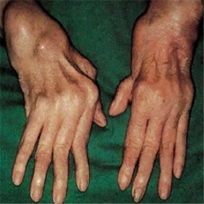 类风湿关节炎有什么治疗方法