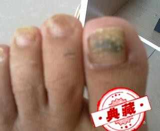 指甲变黑是怎么回事啊?今天突然发生指甲变黑了