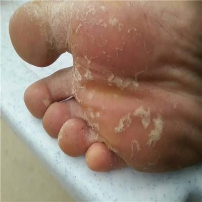 脚底脱皮是什么原因