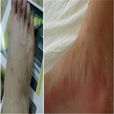 脚底发白很臭怎么办