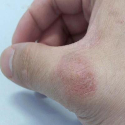 皲裂性湿疹怎么治疗