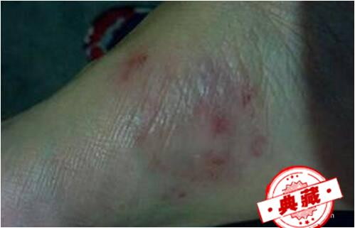 夏天脚底长水泡脱皮出汗怎么办呢?