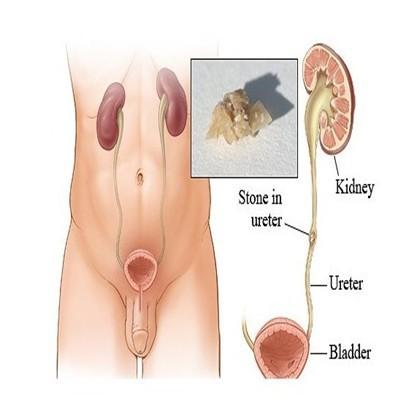 肾结石堵住输尿管怎么办