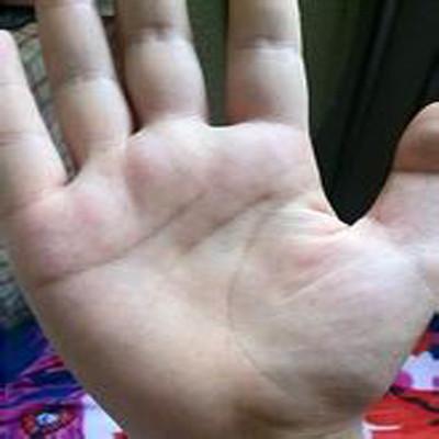 右手第五掌骨骨折怎么办