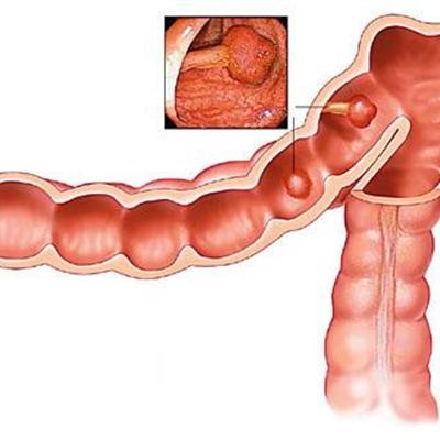 直肠癌手术后能活多久