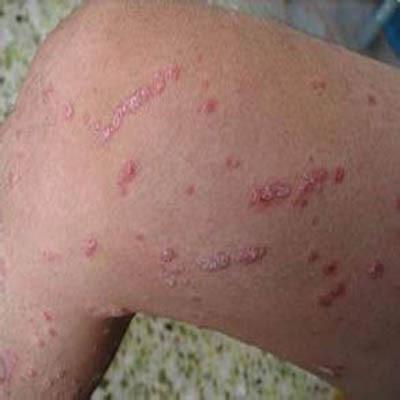 治牛皮鲜有什么药