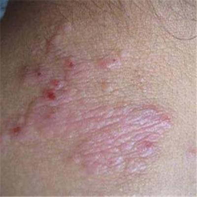 神经性皮炎用什么药膏