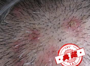 头上长痘痘是什么原因?夏天头上有很多的红痘痘