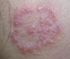 怎样才能根治神经性皮炎