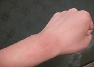 常吃四种食物预防过敏