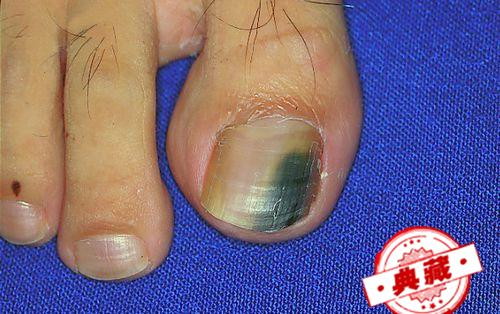 灰指甲治疗对比