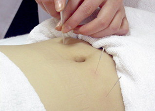 女人针灸减肥要避开的致命陷阱