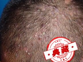 头皮毛囊炎怎么治疗?用什么药?