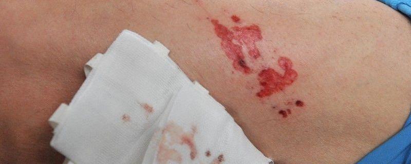 狂犬病为什么怕水 狂犬病为什么怕水 知乎