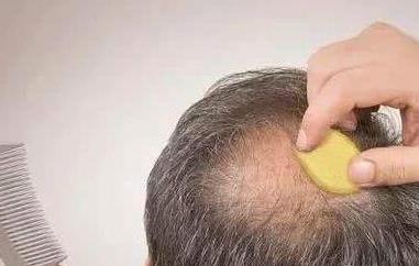 斑秃擦生姜正确方法 斑秃可以用生姜擦吗 要注意什么问题