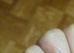 被油烫伤怎么办（被油烫伤怎么办有什么办法快去痛）