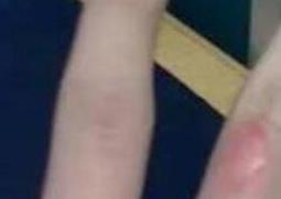 油烫伤起泡后怎么处理 油烫伤起泡了怎么办?