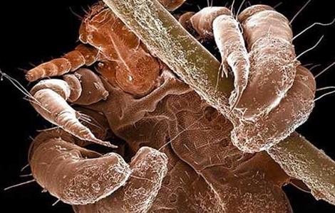 虱子怕什么东西 虱子多了不怕什么