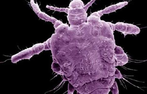 阴虱子怎么治疗才好 阴虱子如何治疗