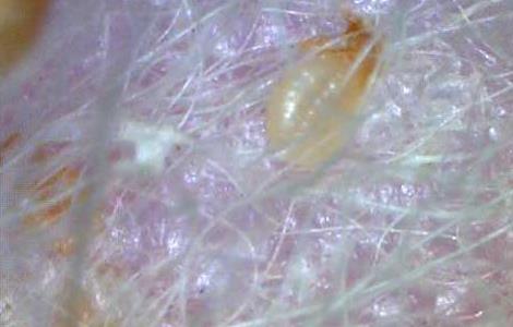 虱子是怎么产生的