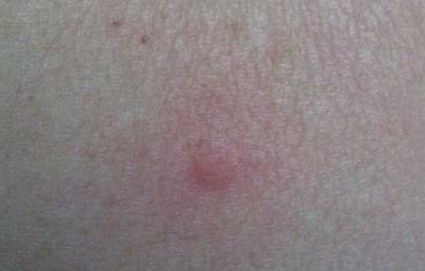 跳蚤咬了有什么症状 跳蚤咬了有什么症状图片