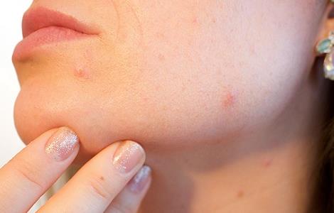 皮肤过敏者的饮食禁忌（皮肤过敏者的饮食禁忌是什么）