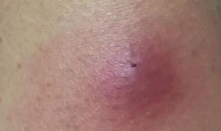 为什么被蚊子咬了会痛（为什么被蚊子咬了会很痛）