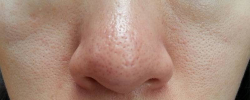 怎样去黑头？ 怎样去黑头小学生