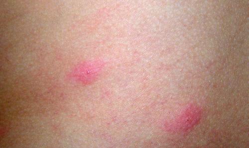 湿疹荨麻疹（湿疹荨麻疹吃什么药最有效）