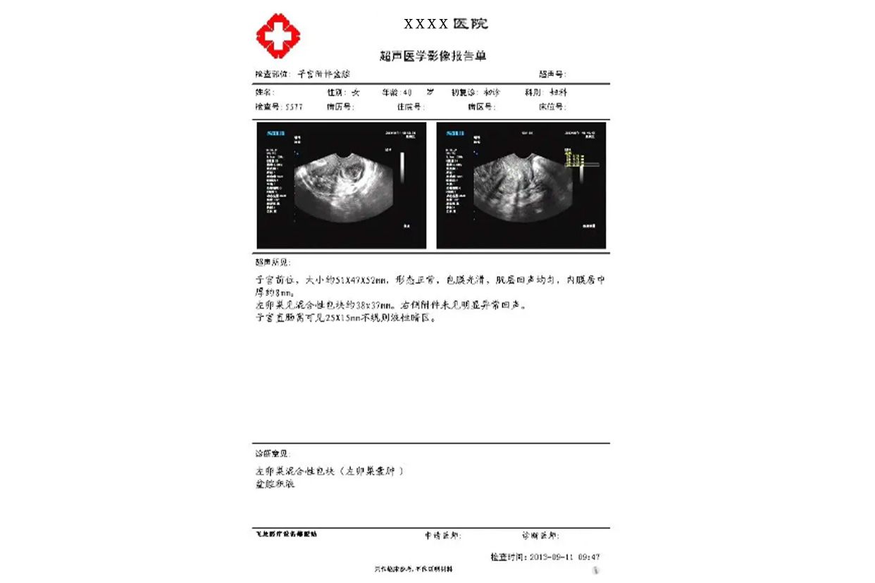 卵巢囊肿诊断证明图片 卵巢囊肿的诊断证明