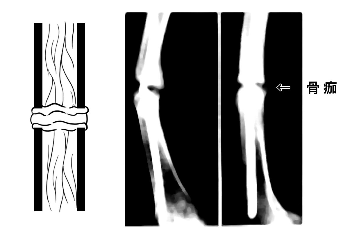骨痂初期图片（骨痂是什么样子图片）