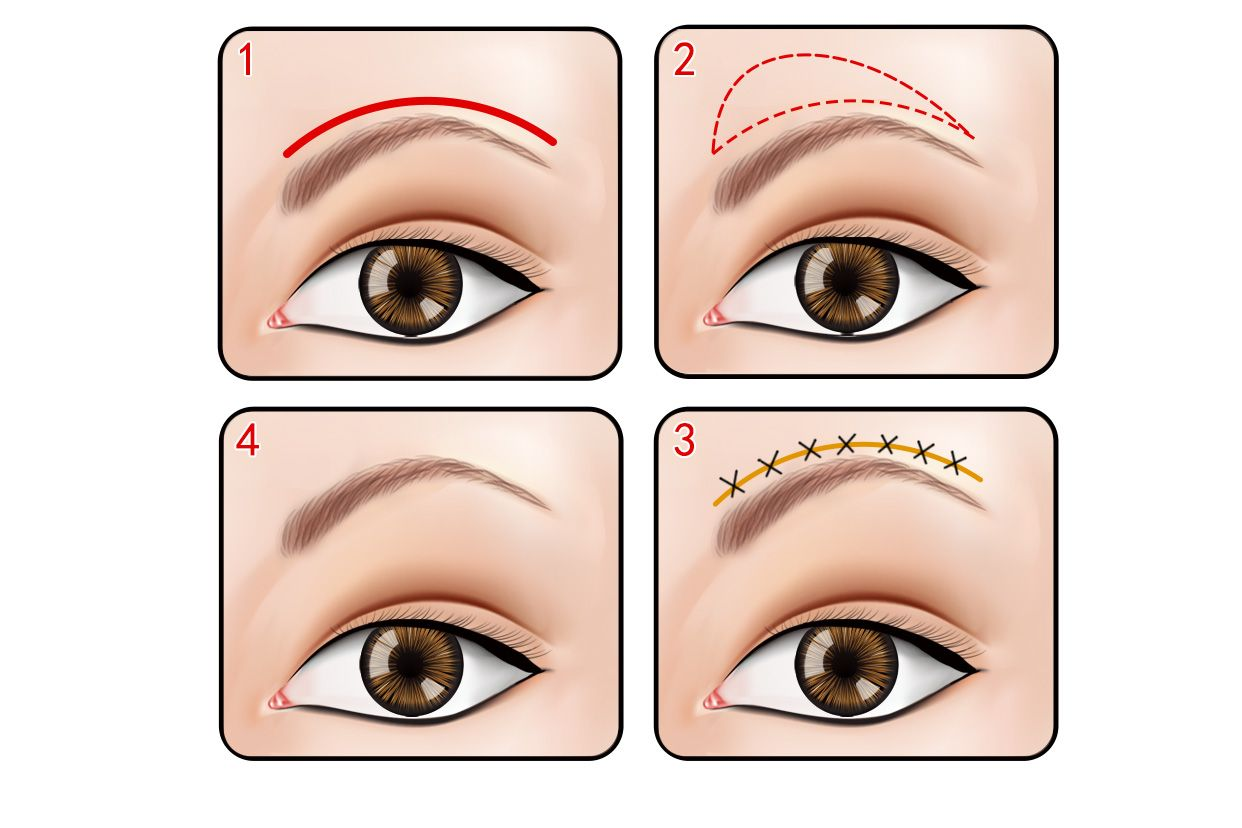 提眉手术效果图 提眉手术效果图片
