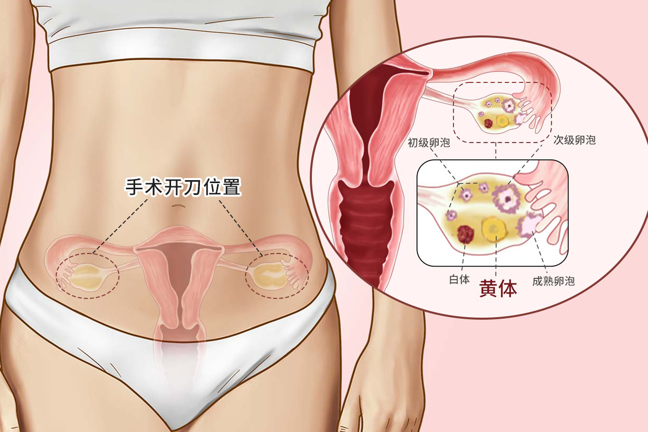 黄体破裂开刀位置图片 黄体破裂手术疤痕图片