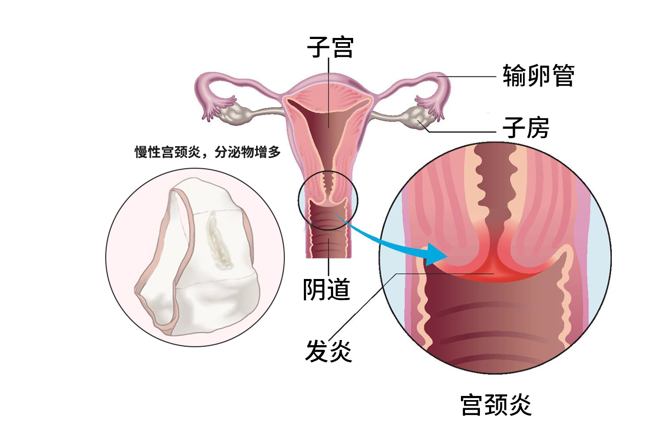 慢性宫颈炎内裤的图片 宫颈炎内裤症状图片