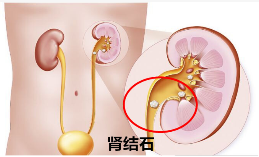 肾结节图片（肾结节是什么东西）