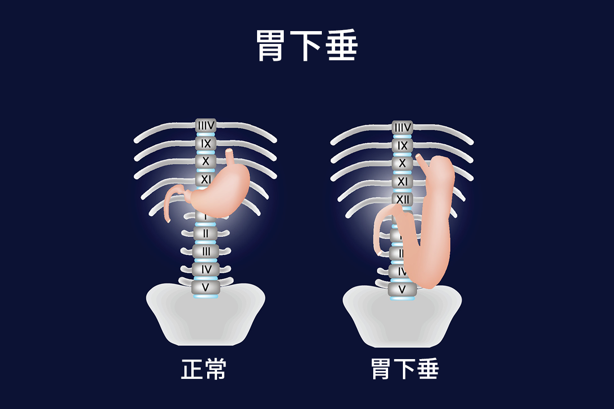 胃下垂真人图（胃下垂图片人的症状）