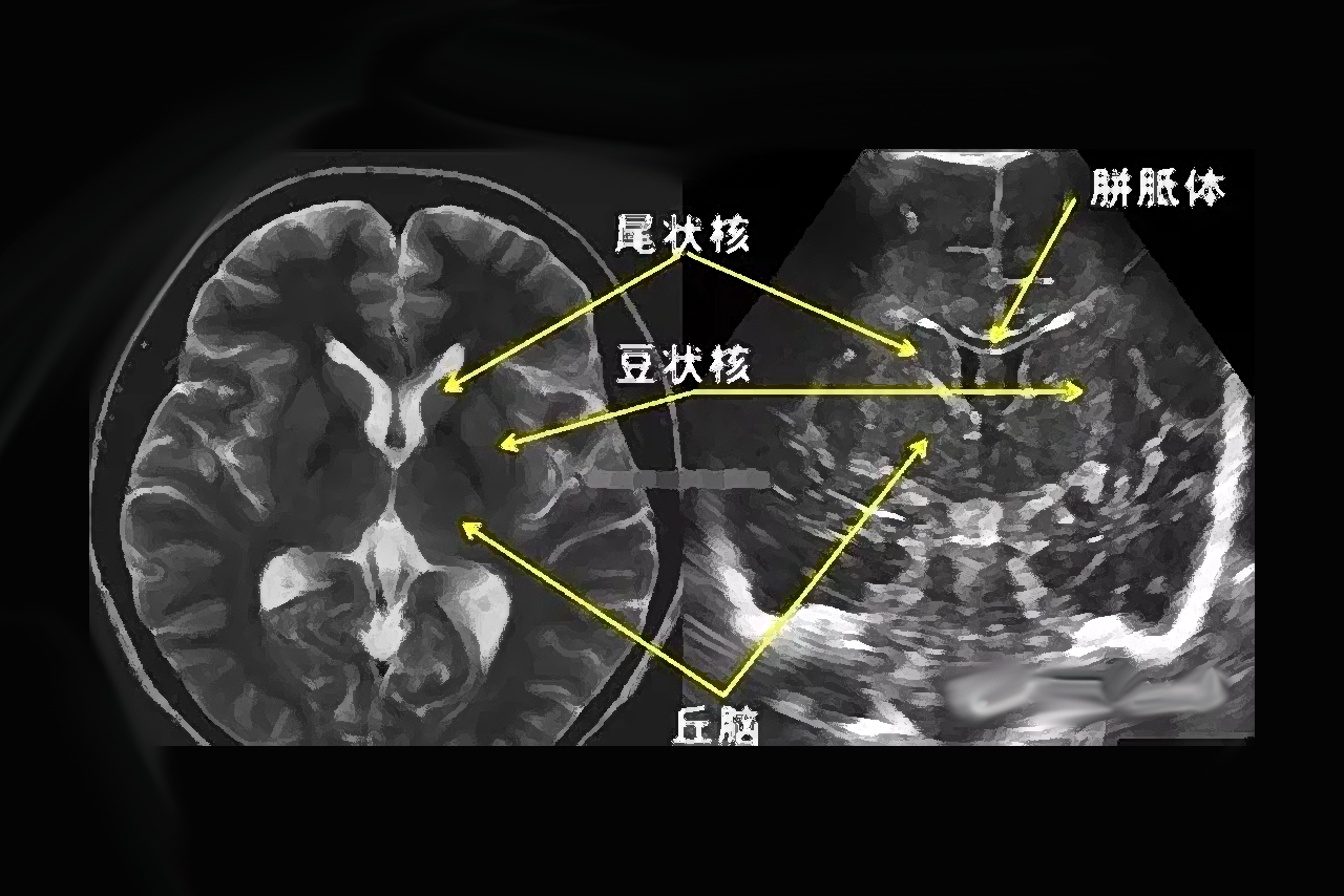 胎儿颅内结构正常超声图谱（新生儿颅脑超声解剖图谱）