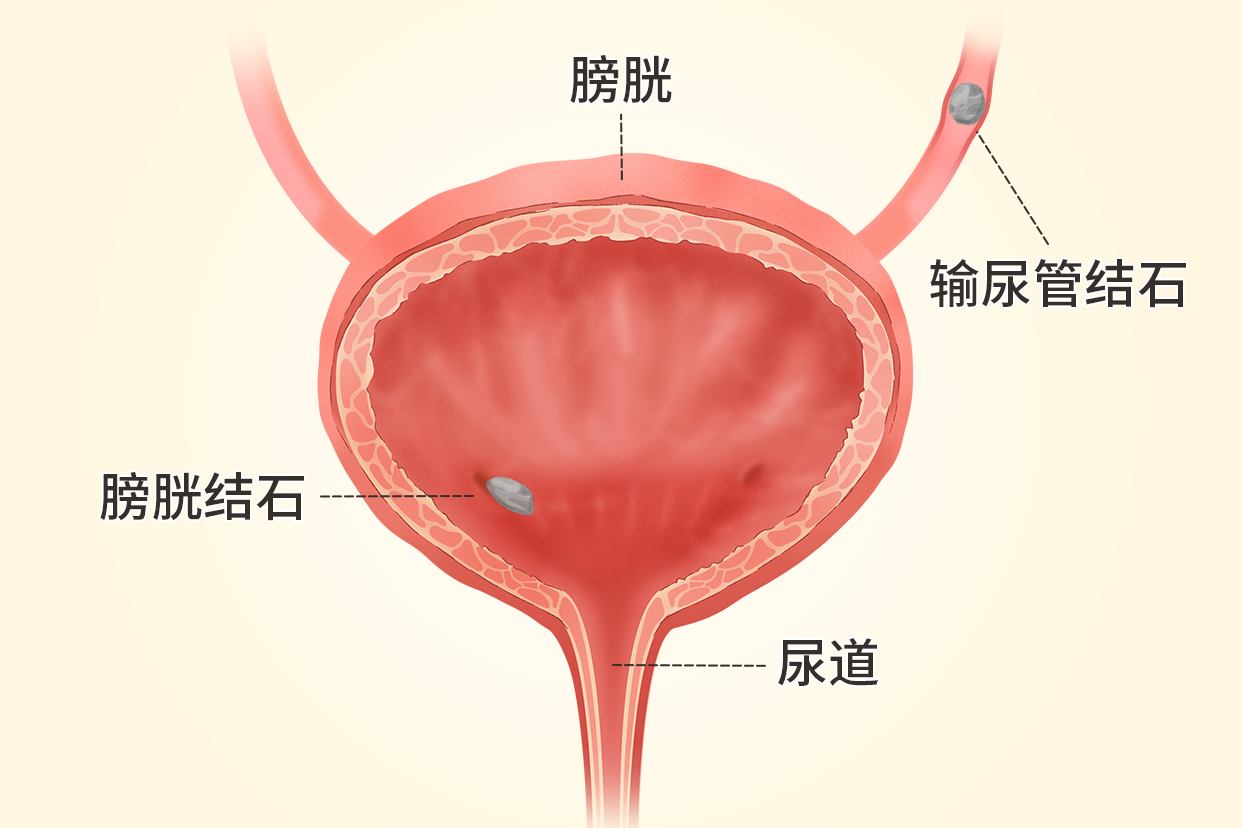 男生膀胱结石在什么位置图片