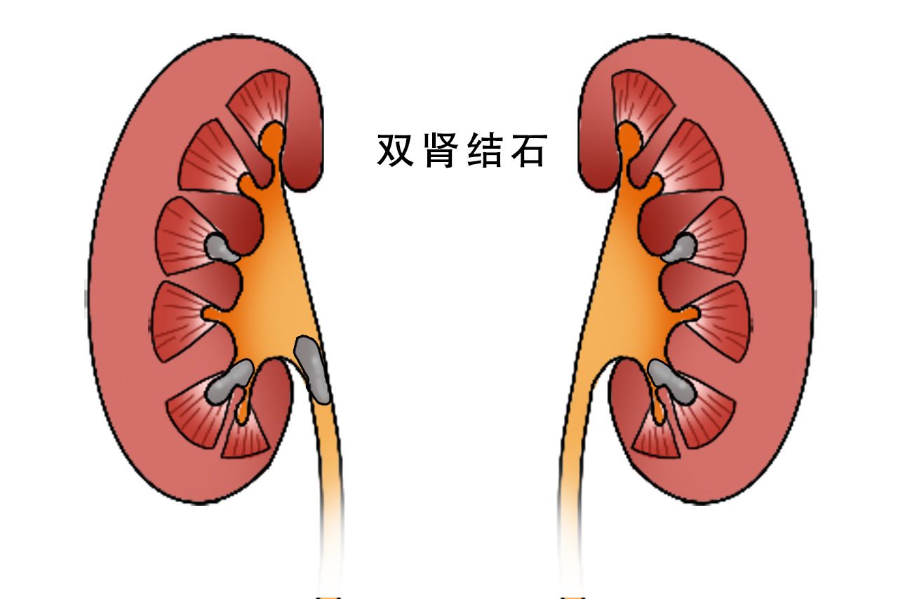 双肾结石图片