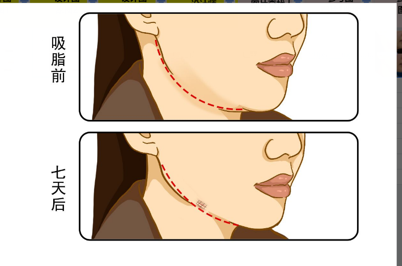 下颌缘吸脂7天恢复图
