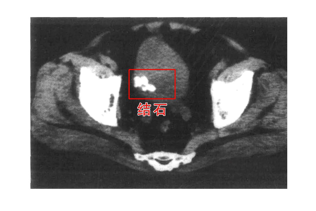 膀胱结石ct图片