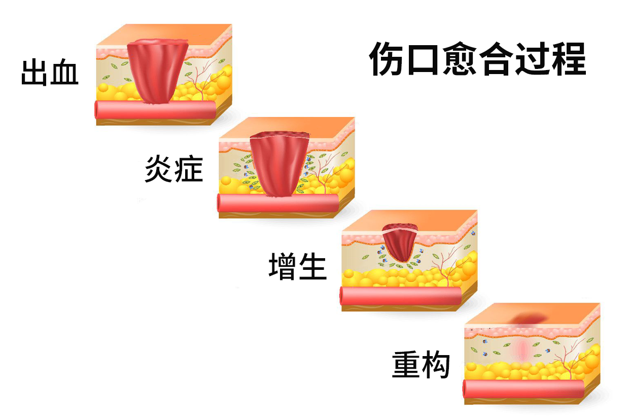 伤口愈合扇形图 手术伤口正常愈合图片