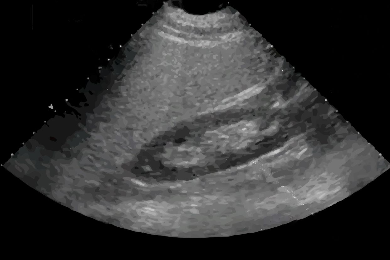 符合脂肪肝声像图是什么意思 脂肪肝声像图是什么意思?