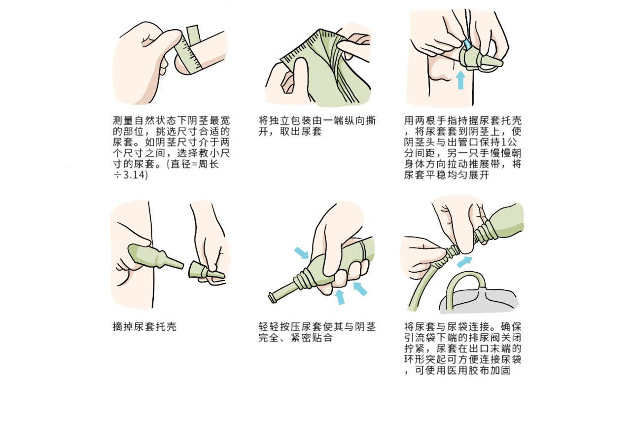 男性一次性尿袋使用图解 男性一次性尿袋使用图解大全