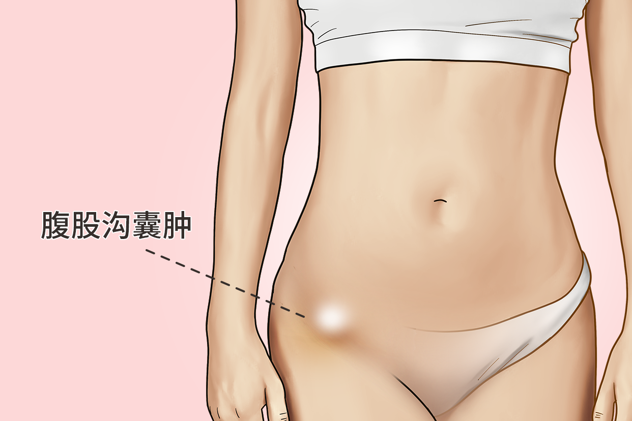 女性腹股沟囊肿图片