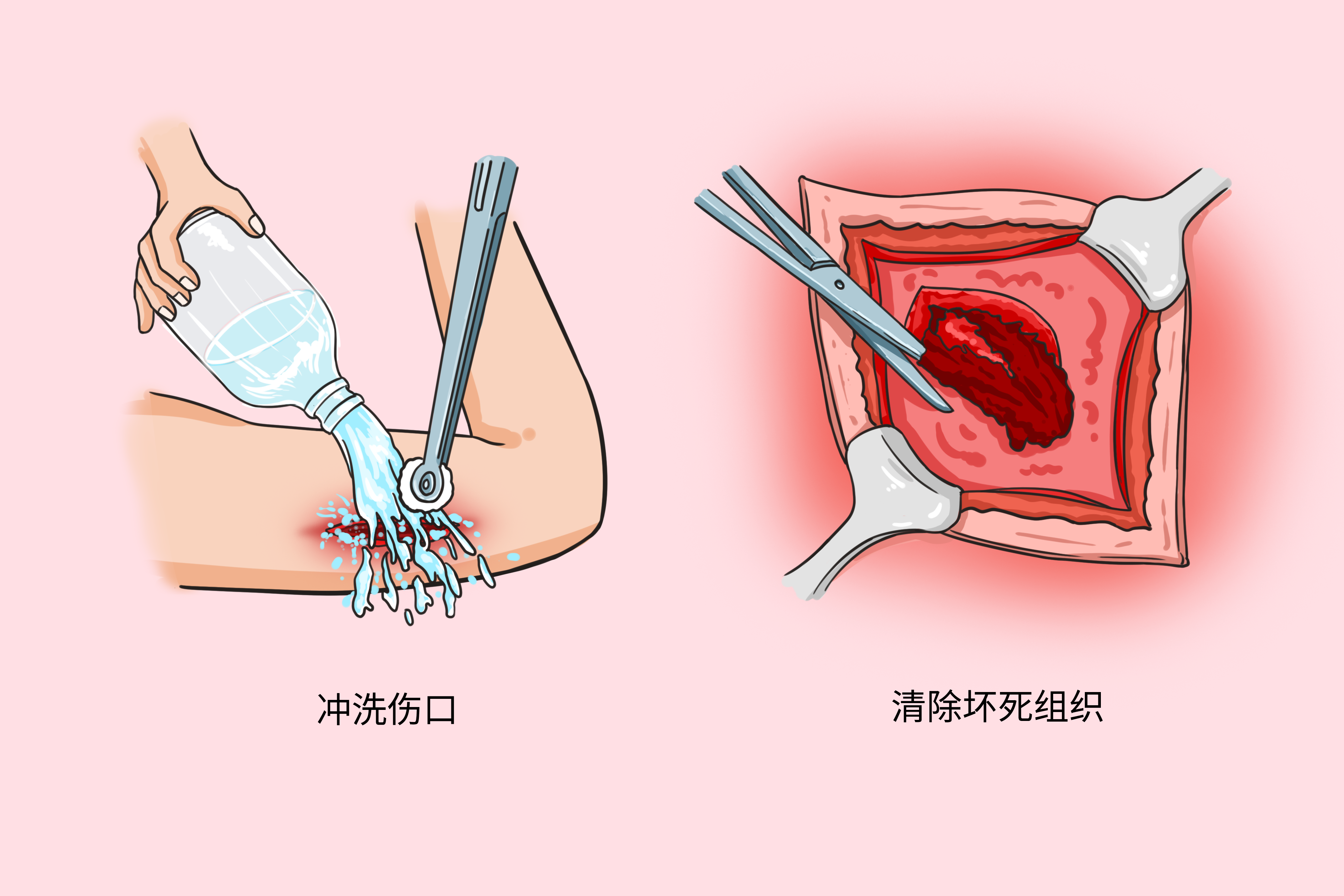 清创缝合图片