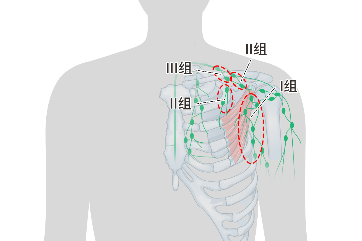 腋窝淋巴结分区第一水平图片