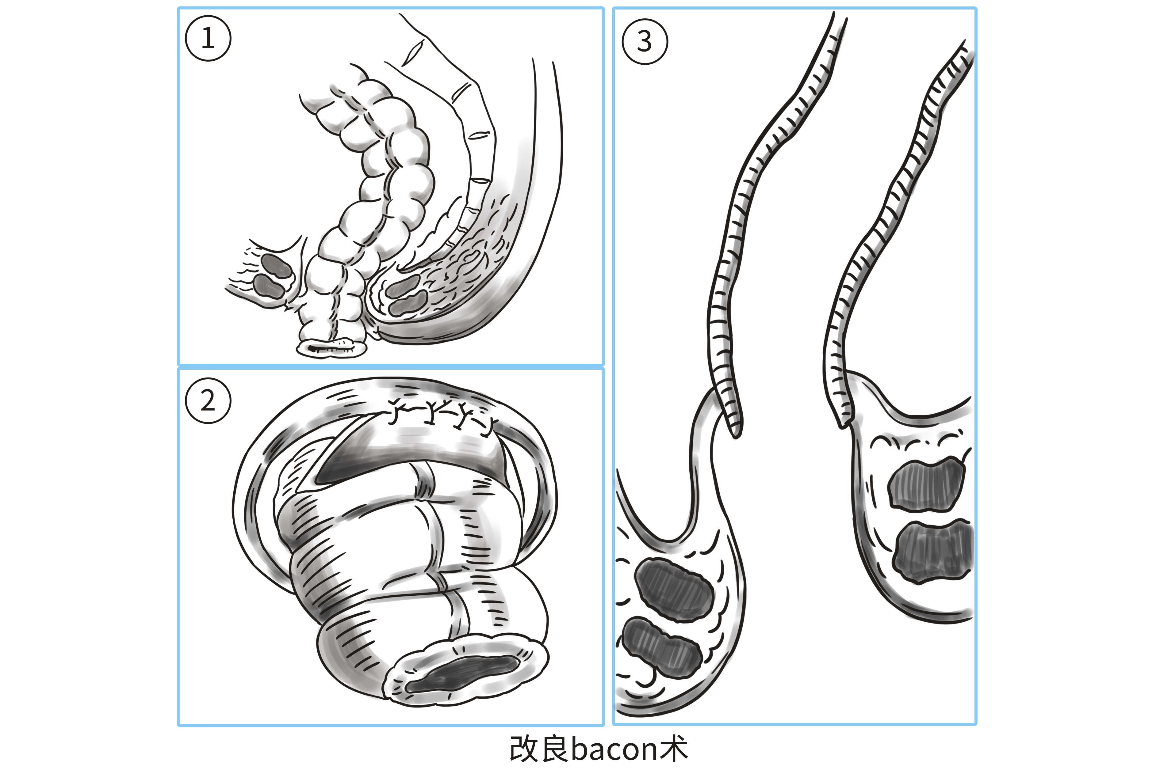 bacon手术示意图