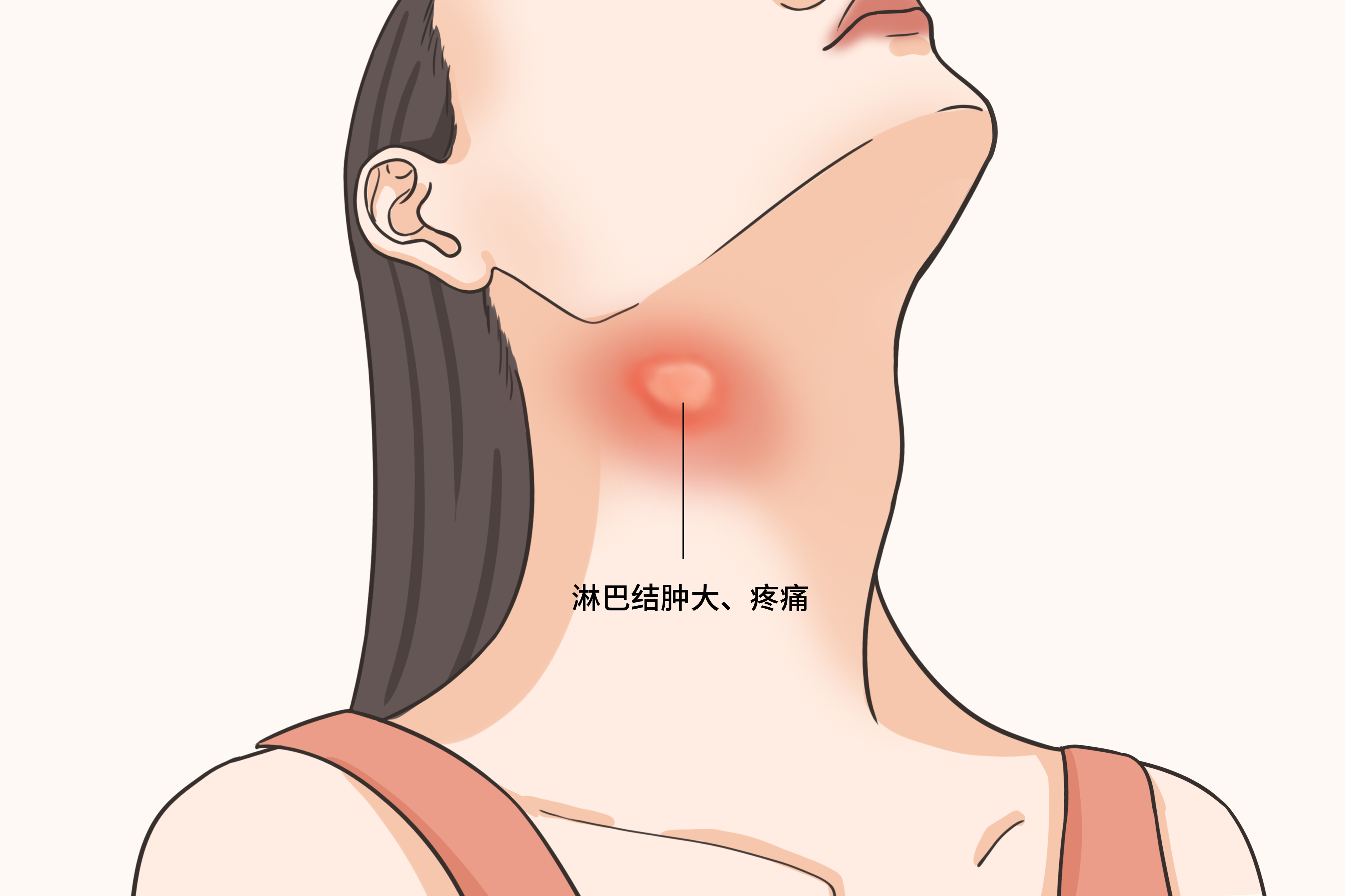 淋巴结肿大是什么颜色图片