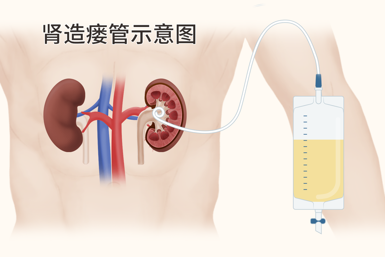 单猪尾样肾造瘘管图片